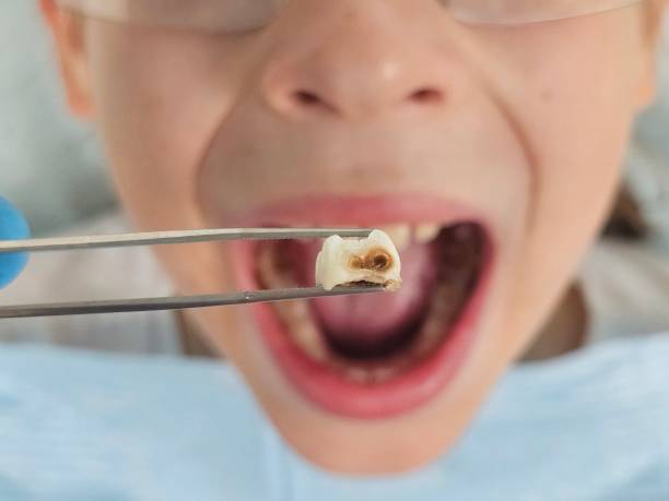 Best Emergency Dentist for Lost Fillings or Crowns in Andale, KS